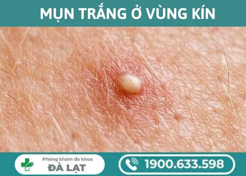TÌM HIỂU ÂM ĐẠO NỔI MỤN TRẮNG VÀ CÁCH ĐIỀU TRỊ HIỆU QUẢ 