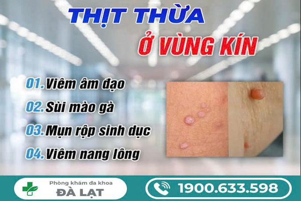 NỔI THỊT THỪA Ở VÙNG KÍN NAM NỮ VÀ CÁCH ĐIỀU TRỊ 