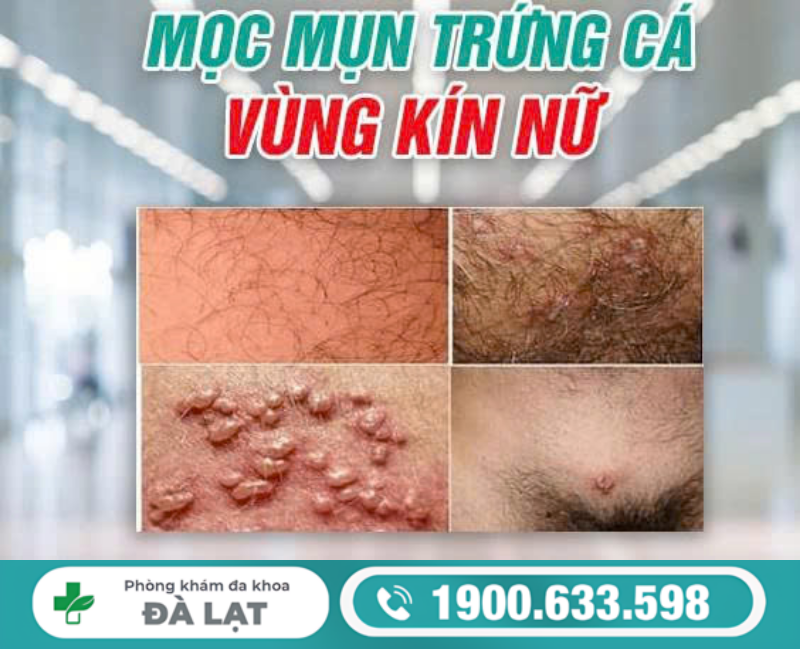 MỤN TRỨNG CÁ Ở VÙNG KÍN NAM NỮ VÀ CÁCH ĐIỀU TRỊ 