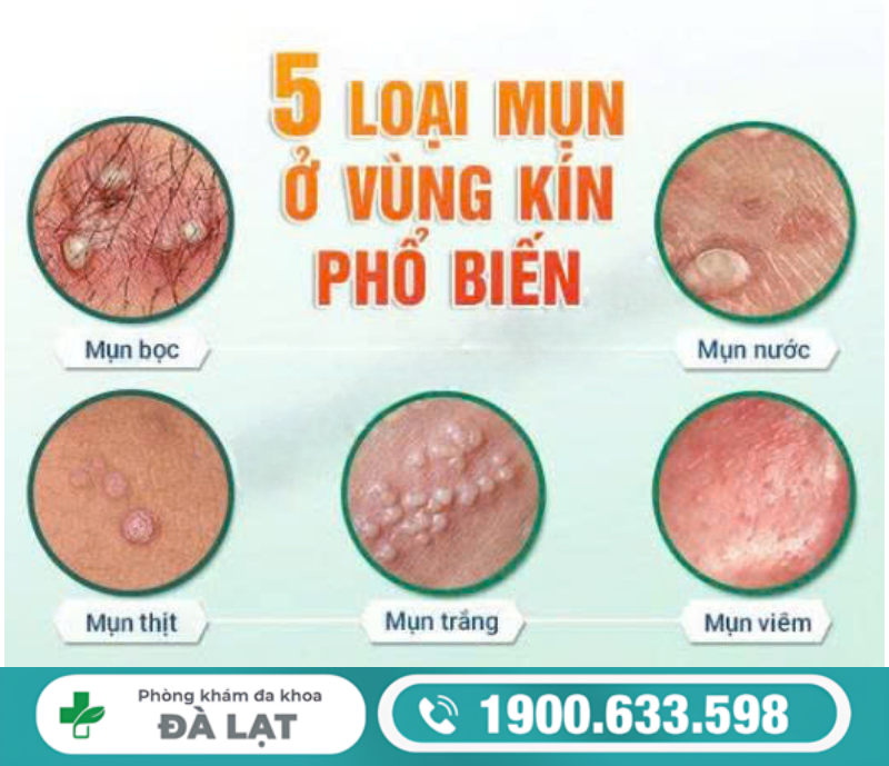 MỌC MỤN HẠCH Ở VÙNG KÍN NAM NỮ VÀ CÁCH ĐIỀU TRỊ 