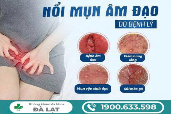 MỤN Ở BỘ PHẬN SINH DỤC NAM GIỚI VÀ NỮ GIỚI LÀ GÌ? CÁCH ĐIỀU TRỊ AN TOÀN VÀ HIỆU QUẢ