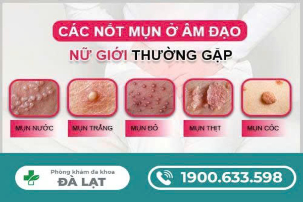 MỌC MỤN TRONG ÂM ĐẠO CẢNH BÁO BỆNH PHỤ KHOA NÀO?