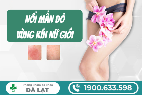 NỔI MẨN ĐỎ Ở VÙNG KÍN NỮ GIỚI