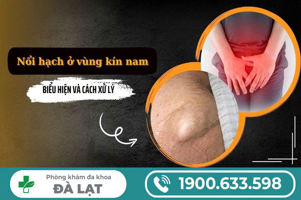 NỔI HẠCH Ở VÙNG KÍN NAM GIỚI