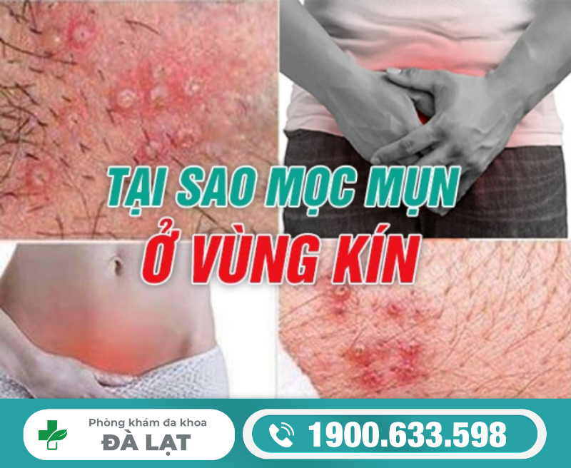 TẠI SAO BỊ MỌC MỤN Ở VÙNG KÍN?