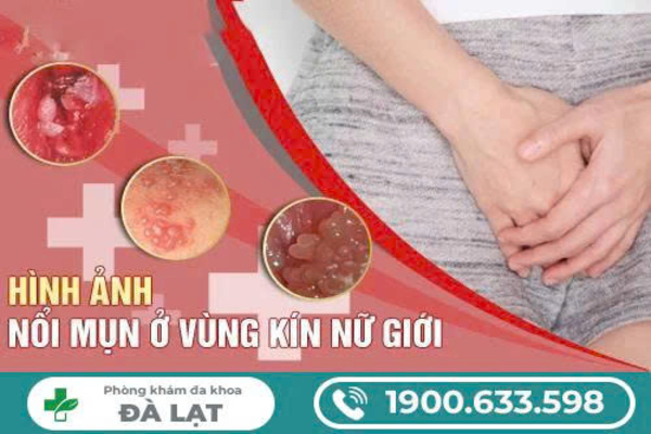 HÌNH ẢNH CÁC LOẠI MỤN VÙNG KÍN NỮ GIỚI