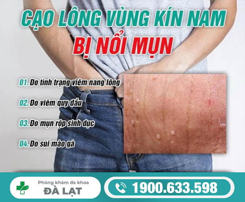 CẠO LÔNG VÙNG KÍN NAM BỊ NỔI MỤN: NGUYÊN NHÂN VÀ CÁCH ĐIỀU TRỊ HIỆU QUẢ