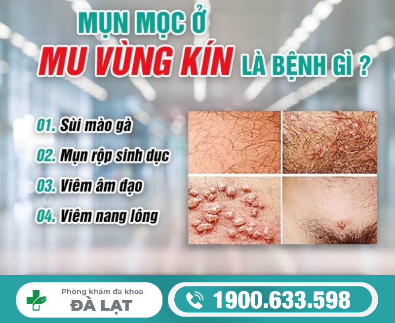 BỊ MỌC MỤN Ở MU VÙNG KÍN