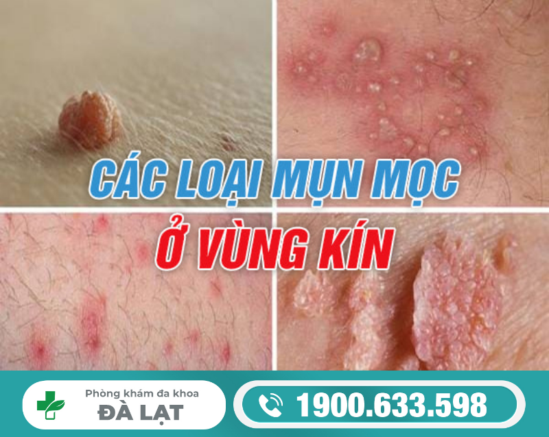 HÌNH ẢNH CÁC LOẠI MỤN VÙNG KÍN