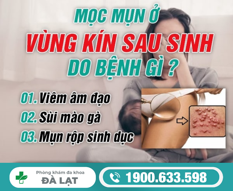 MỌC MỤN Ở VÙNG KÍN SAU SINH