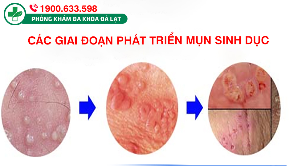 BỊ NỔI MỤN Ở MÔI LỚN VÙNG KÍN