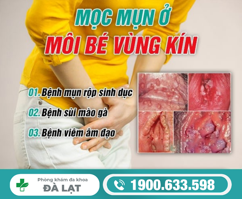 MỌC MỤN Ở MÔI BÉ VÙNG KÍN