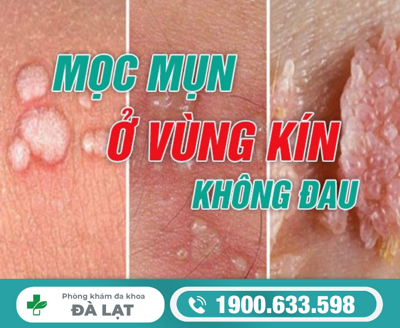MỌC MỤN Ở VÙNG KÍN KHÔNG ĐAU