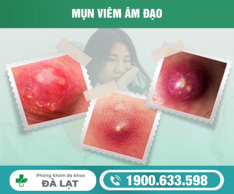 NỔI MỤN DO BỆNH VIÊM ÂM ĐẠO