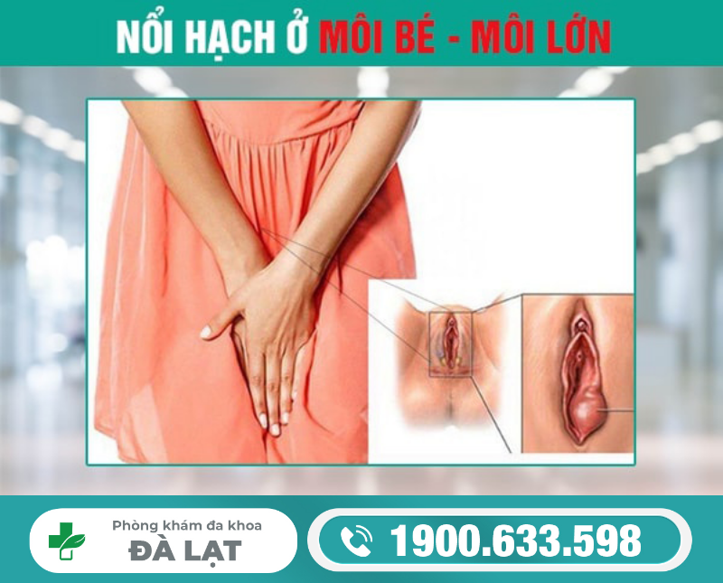 NỔI HẠCH Ở MÔI BÉ & MÔI LỚN VÙNG KÍN NỮ GIỚI