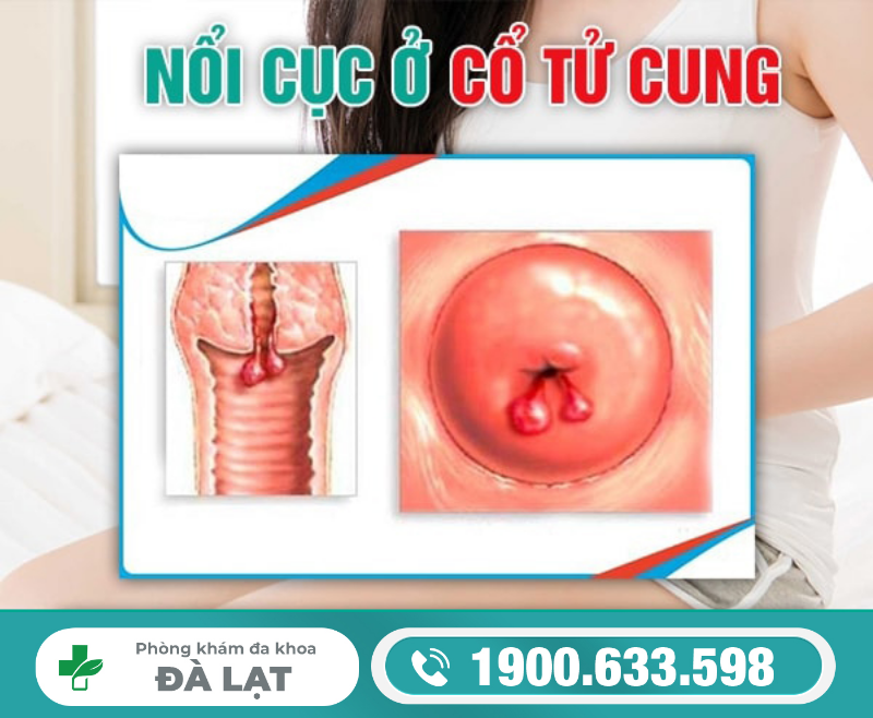 NỔI CỤC Ở CỔ TỬ CUNG LÀ BỆNH GÌ? PHƯƠNG PHÁP ĐIỀU TRỊ HIỆU QUẢ
