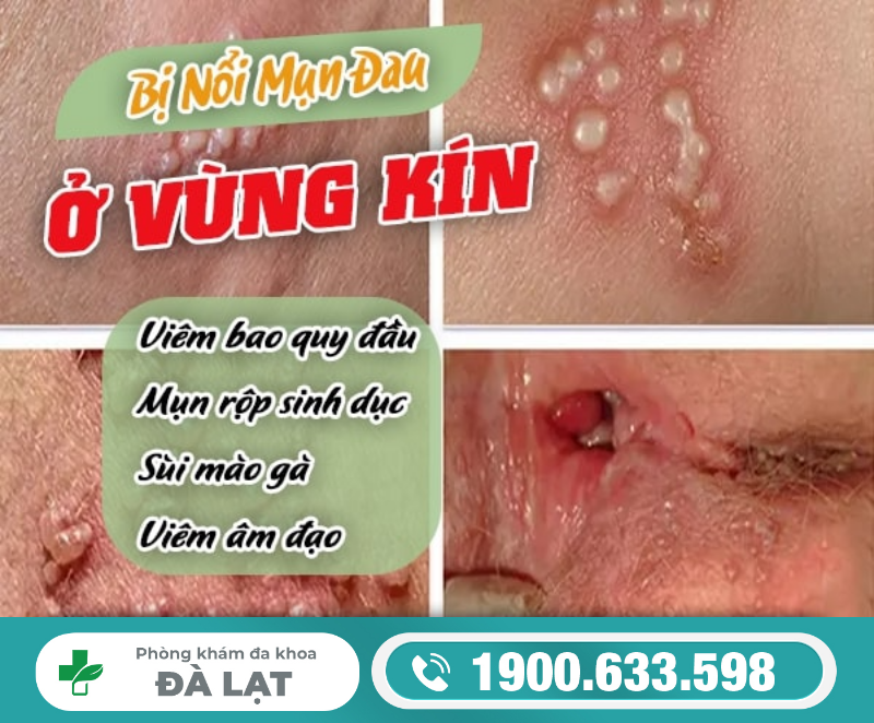 BỊ MỤN SƯNG ĐAU Ở VÙNG KÍN