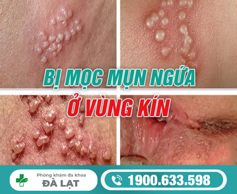 BỊ MỌC MỤN NGỨA Ở VÙNG KÍN