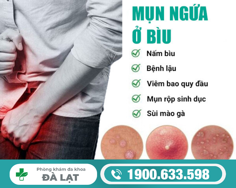NỔI MẨN ĐỎ NGỨA Ở BÌU