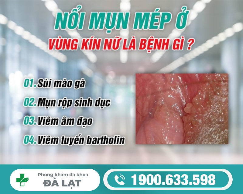 NỔI MỤN Ở MÉP VÙNG KÍN NỮ