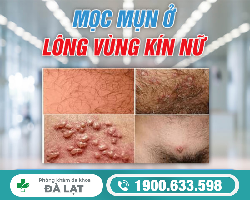 MỌC MỤN Ở LÔNG VÙNG KÍN NỮ GIỚI