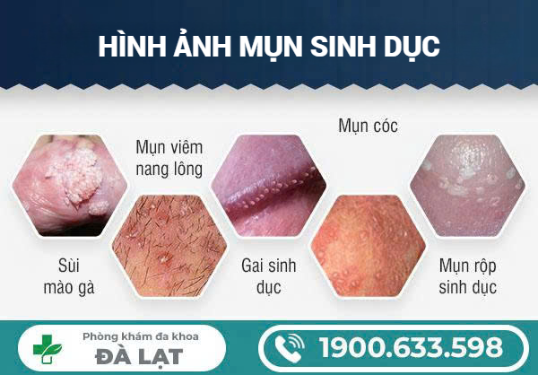 MỤN SINH DỤC Ở VÙNG KÍN NAM LÀ GÌ?