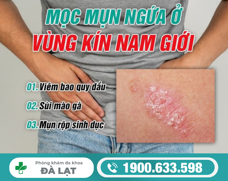 MỌC MỤN NGỨA Ở VÙNG KÍN NAM