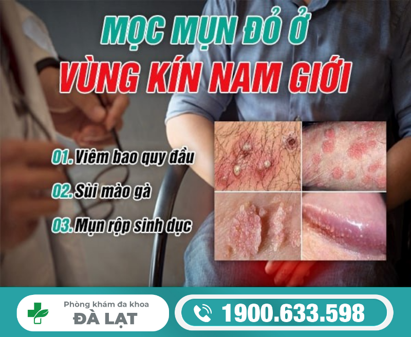 MỌC MỤN ĐỎ Ở VÙNG KÍN NAM GIỚI