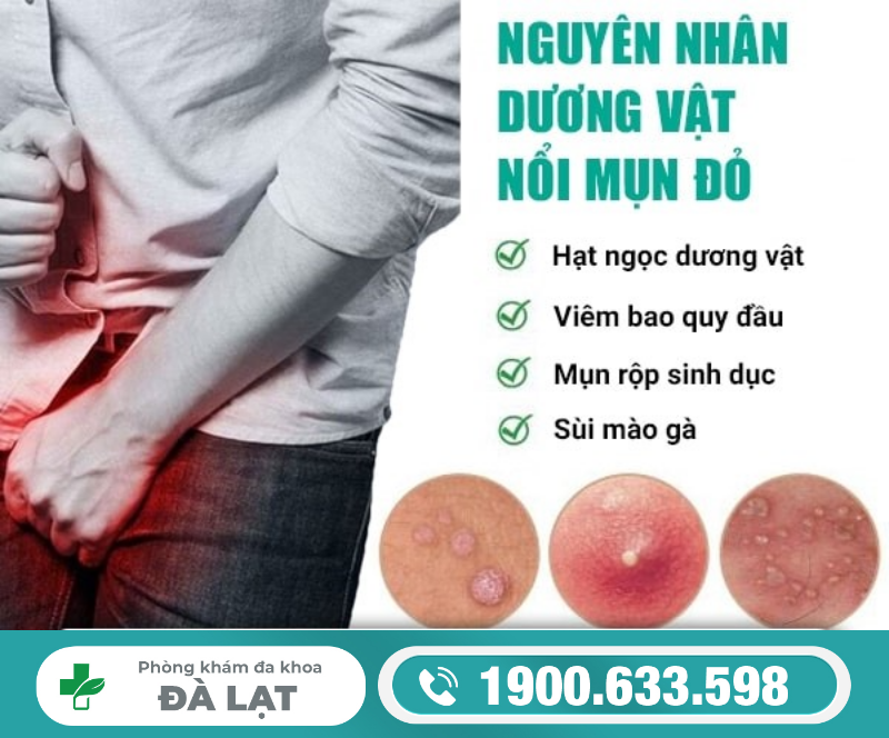 DƯƠNG VẬT NỔI MỤN ĐỎ