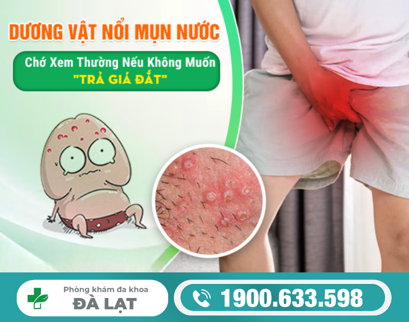 DƯƠNG VẬT NỔI MỤN NƯỚC