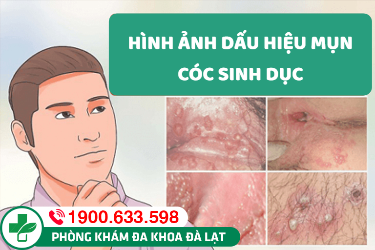 DƯƠNG VẬT NỔI MỤN CÓC