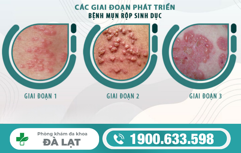 DƯƠNG VẬT NỔI MỤN RỘP