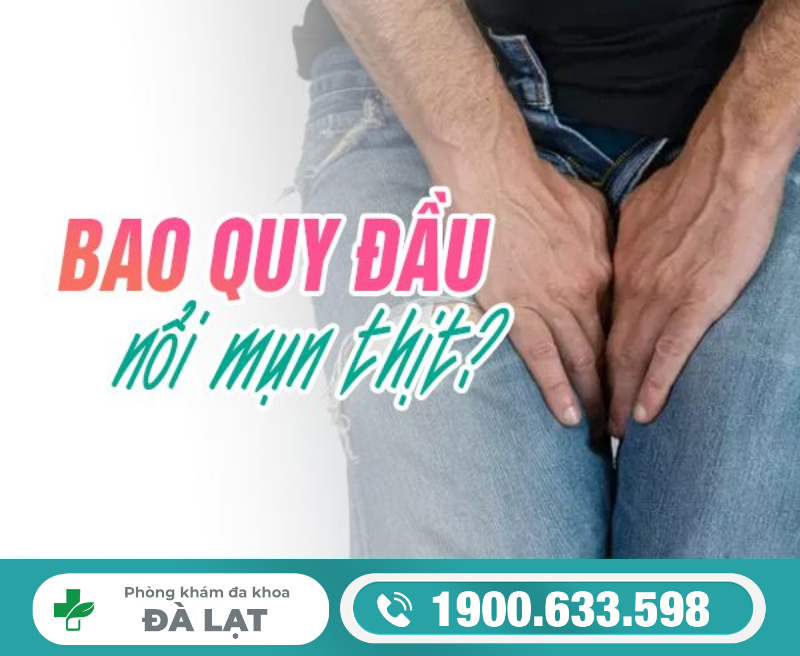 NỔI MỤN THỊT Ở BAO QUY ĐẦU
