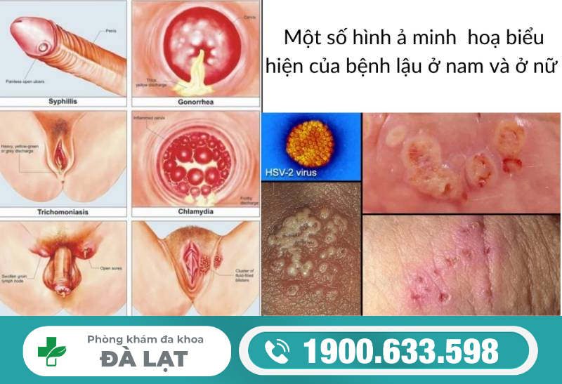 TÌM HIỂU VỀ XÉT NGHIỆM LẬU