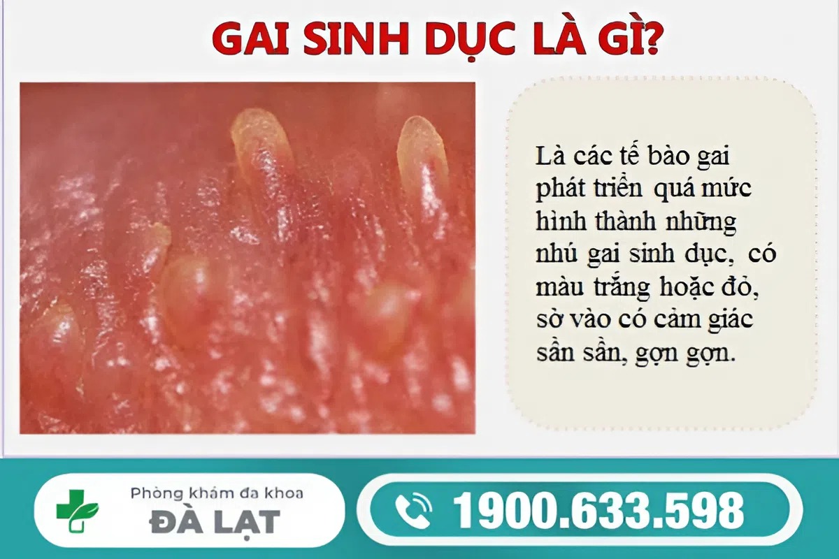 Nhận Biết Sùi Mào Gà và Gai Sinh Dục 