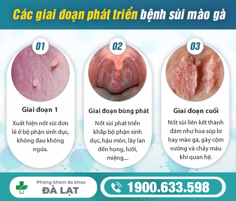 Các Giai Đoạn Của Sùi Mào Gà 