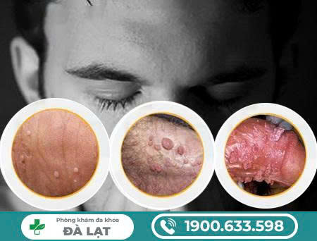 Bệnh Sùi Mào Gà Giai Đoạn 2