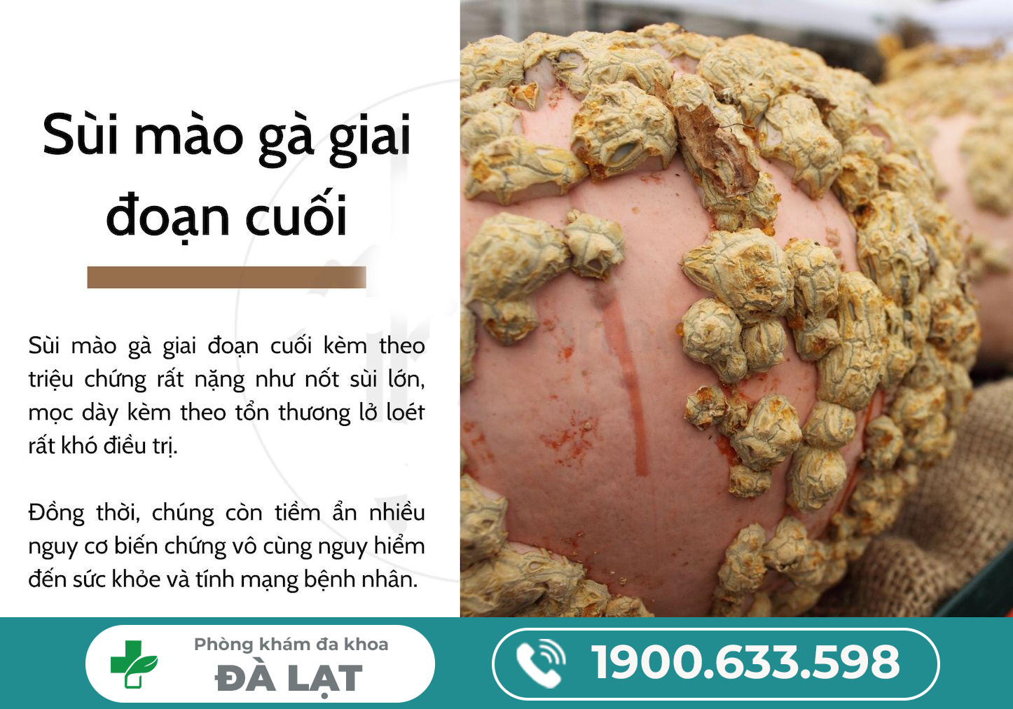 Bệnh Sùi Mào Gà Giai Đoạn Nặng 