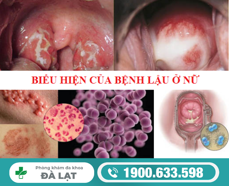 TIM HIỂU GIAI ĐOẠN ĐẦU BỆNH LẬU Ở NỮ