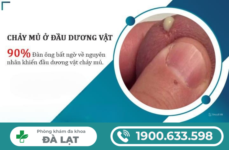 TÌM HIỂU VỀ DƯƠNG VẬT CHẢY DỊCH VÀNG Ở NAM GIỚI 