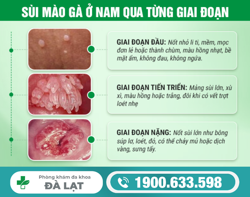 TÌM HIỂU VỀ XÉT NGHIỆM BỆNH SÙI MÀO GÀ Ở NAM GIỚI