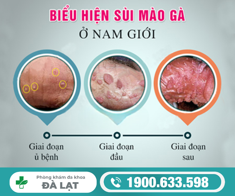 TÌM HIỂU VỀ BỆNH SÙI MÀO GÀ GIAI ĐOẠN ĐẦU Ở NAM GIỚI