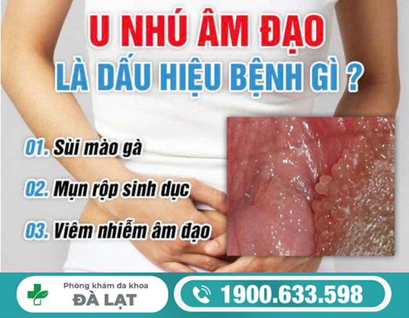 TÌM HIỂU U NHÚ SINH DỤC Ở NỮ VÀ CÁCH ĐIỀU TRỊ HIỆU QUẢ 