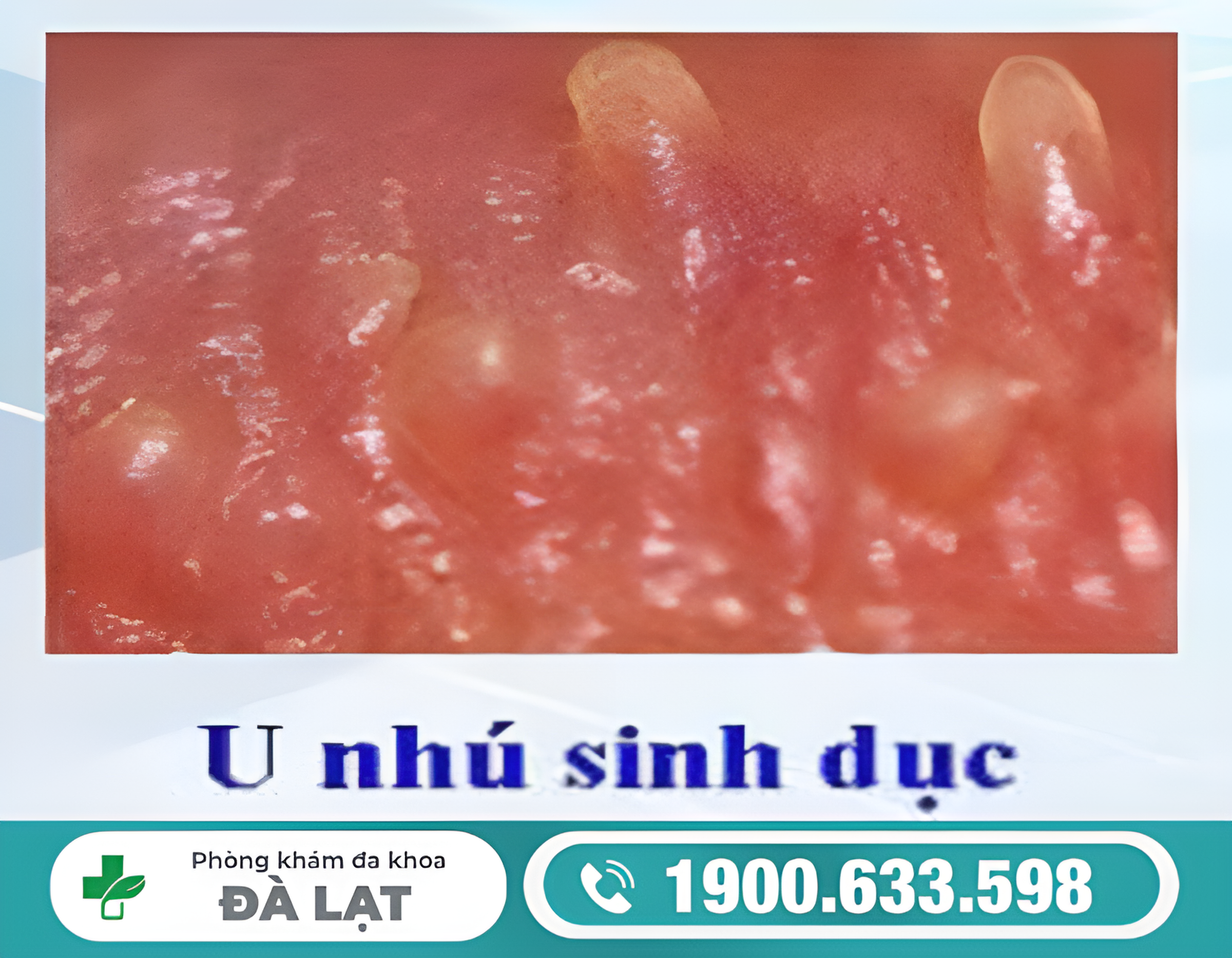 TÌM HIỂU VỀ U SINH DỤC Ở NAM VÀ CÁCH ĐIỀU TRỊ 